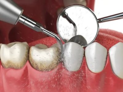 Лечение пародонтита (пародонтоза)