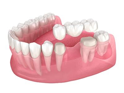 Протезирование