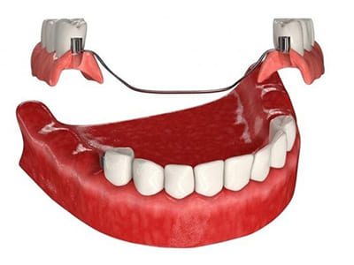 Бюгельное протезирование